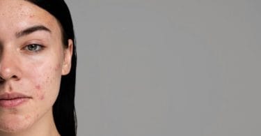 melhores hidratantes para pele acneica