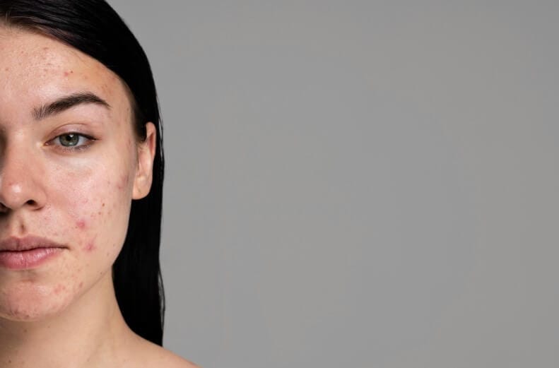 melhores hidratantes para pele acneica